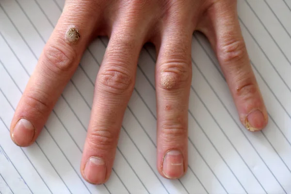 Warts Hand Finger Close — Stock Photo, Image