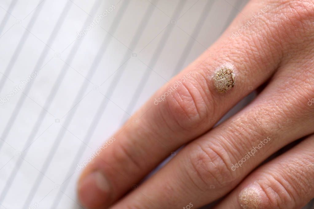 Warts on the hand finger, close up