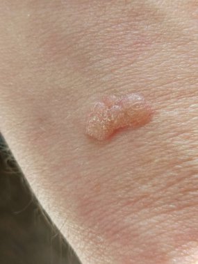 Parmağında siğil var, kapat.