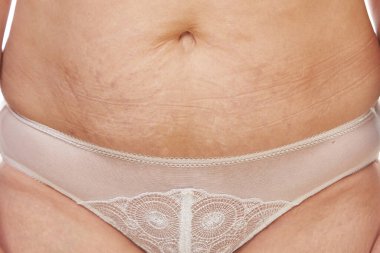 Doğum sonrası gerilme izleri olan 40 yaşında bir kadının karnı.