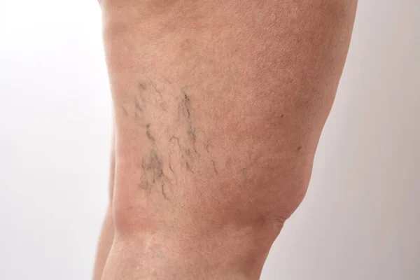 Ноги Летней Женщины Растяжками Целлюлитом Варикозным Расширением Вен — стоковое фото