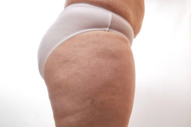 Kırk yaşında, esneme izleri, selülit ve varisli beyaz izole edilmiş arka planda damarları olan bir kadının bacakları ve kalçaları.