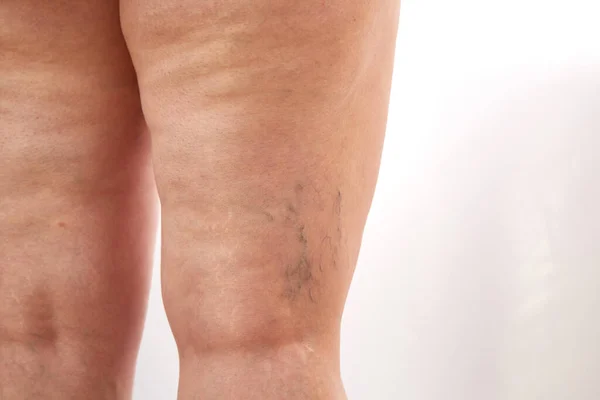 legs of a 40-year-old woman with stretch marks, cellulite and varicose veins close-up