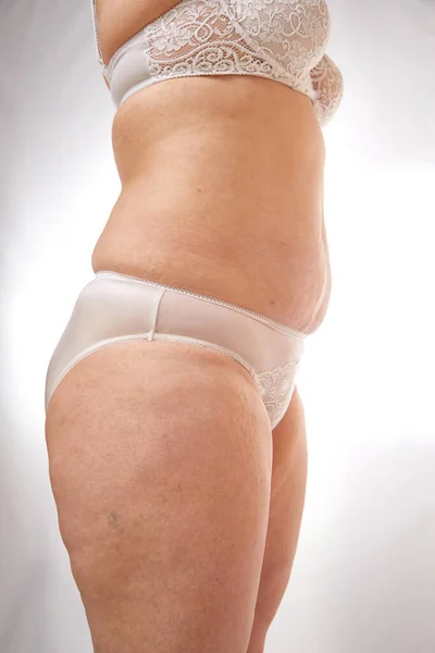 Piernas Nalgas Estómago Una Mujer Años Con Estrías Celulitis Venas — Foto de Stock