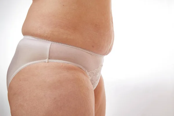 Piernas Nalgas Una Mujer Años Con Estrías Celulitis Varices Sobre — Foto de Stock