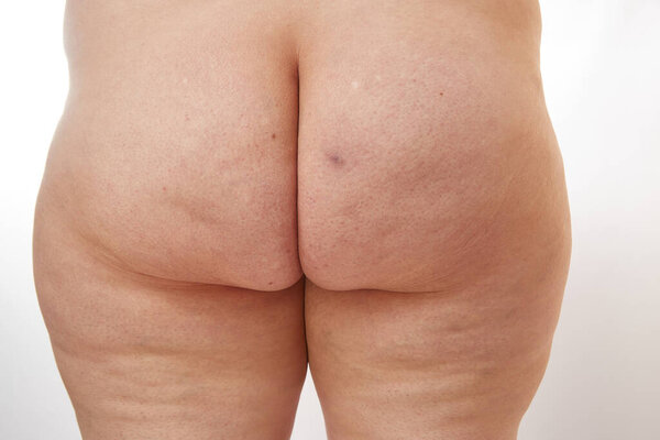 legs and buttocks of a 40-year-old woman with stretch marks, cellulite and varicose veins on a white isolated background