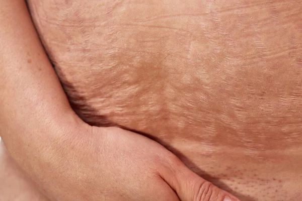 belly of a 40 year old woman with postpartum stretch marks close up