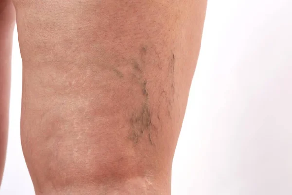 Piernas Una Mujer Años Con Estrías Celulitis Venas Varicosas Cerca — Foto de Stock