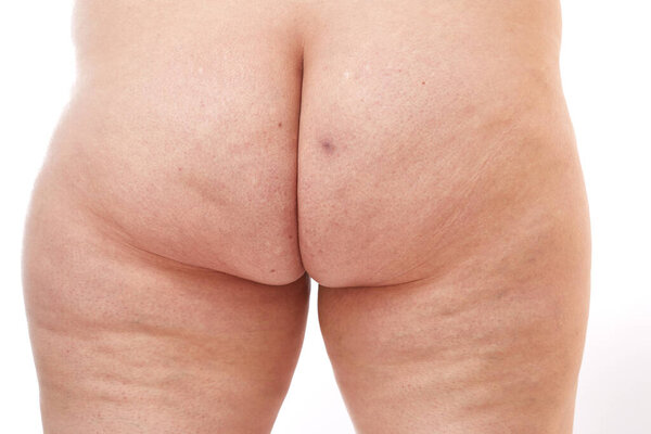 legs and buttocks of a 40-year-old woman with stretch marks, cellulite and varicose veins on a white isolated background