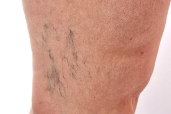 Ноги Летней Женщины Растяжками Целлюлитом Варикозным Расширением Вен — стоковое фото