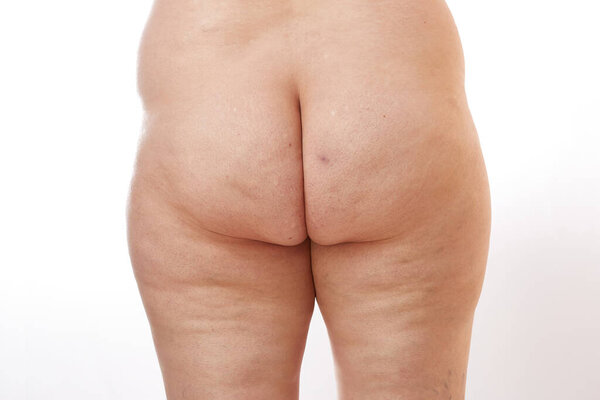 legs and buttocks of a 40-year-old woman with stretch marks, cellulite and varicose veins on a white isolated background