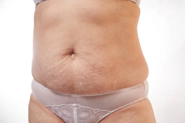 Piernas Vientre Una Mujer Años Con Estrías Celulitis Exceso Peso — Foto de Stock