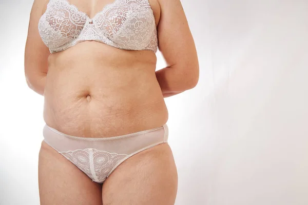 Piernas Vientre Una Mujer Años Con Estrías Celulitis Exceso Peso — Foto de Stock