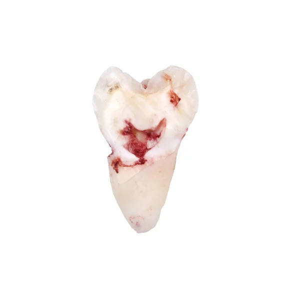 Extracted wisdom tooth, inner view