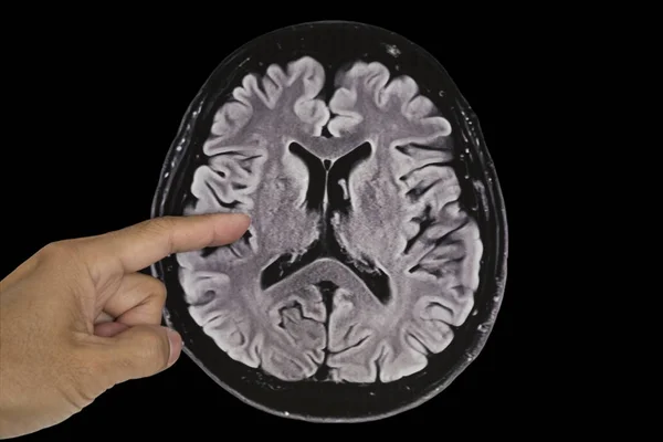 Lidský mozek MRI, axiální pohled — Stock fotografie