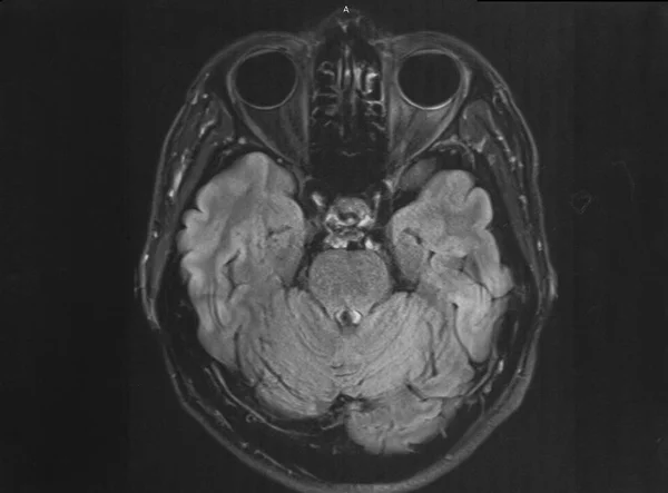 Ανθρώπινος εγκέφαλος μαγνητική τομογραφία, αξονική όψη — Φωτογραφία Αρχείου