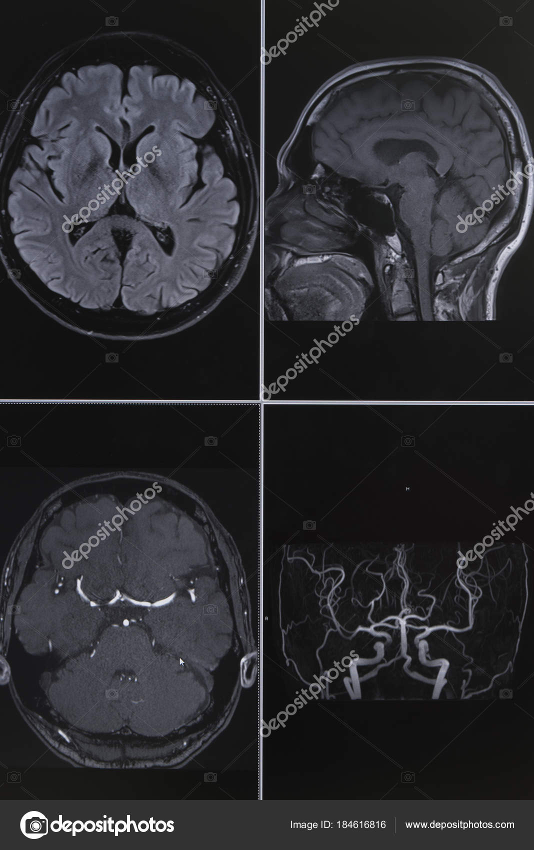 para que es una resonancia magnetica cerebral