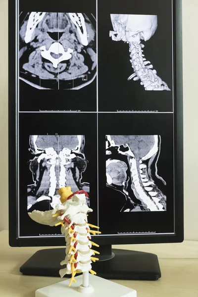 Model kręgosłupa szyjnego i Mri w lekarza pakietu office — Zdjęcie stockowe
