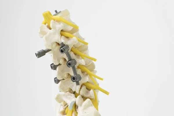 Modelo da coluna vertebral humana com fixação do instrumento — Fotografia de Stock