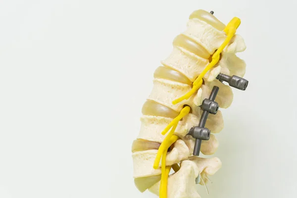 带器械固定的腰椎模型 — 图库照片
