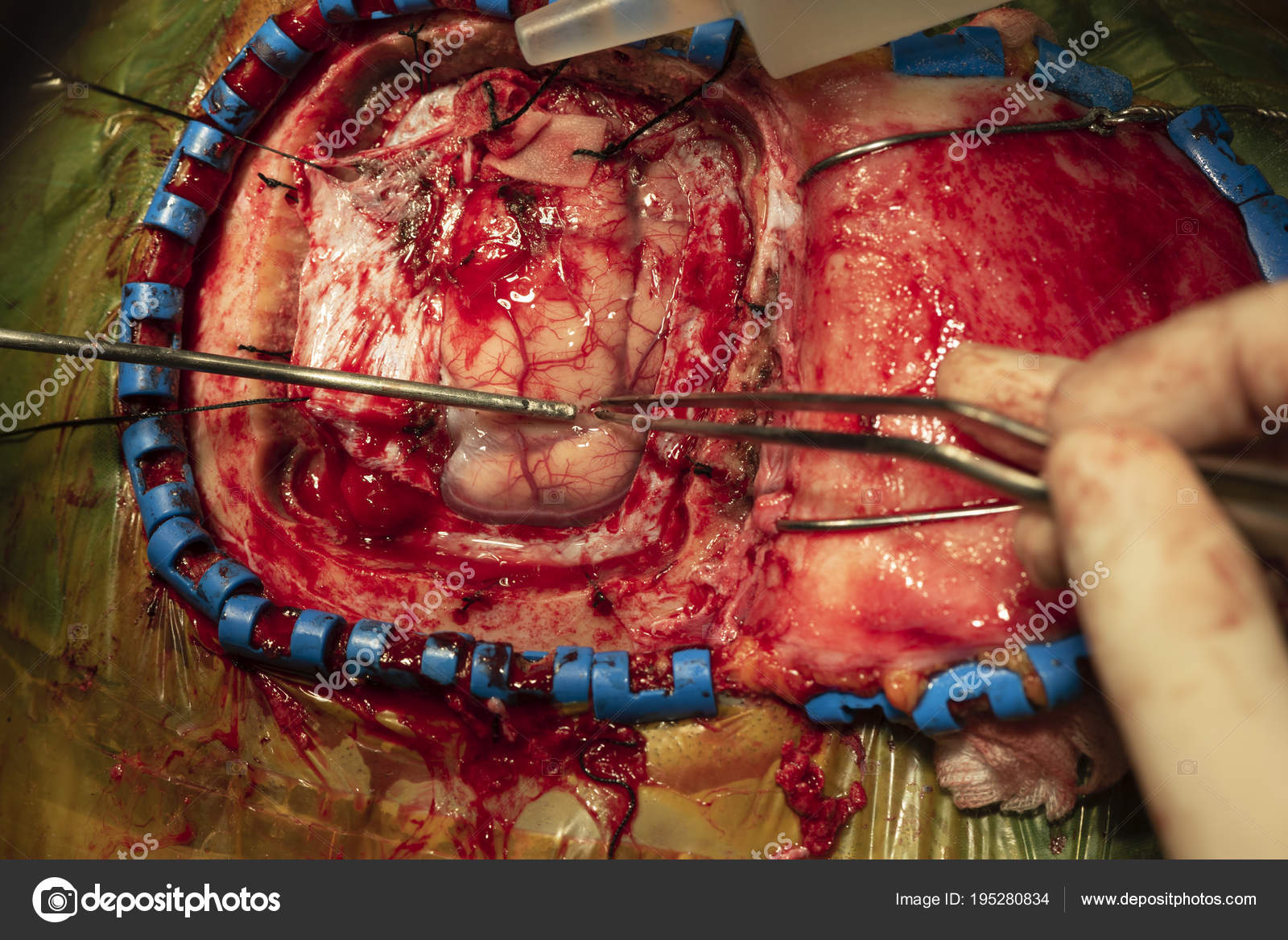 Neurosurgeon performing brain tumor surgery — Stock ...