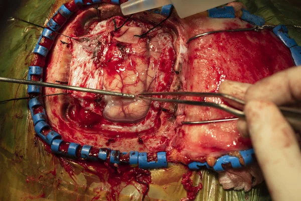 Neurochirurg provádějícího operaci nádoru mozku — Stock fotografie