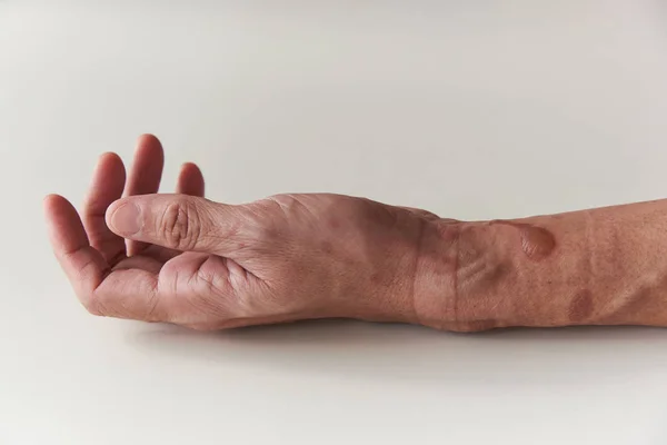 Sol ön kol ve bilekte ikinci derece yanık.