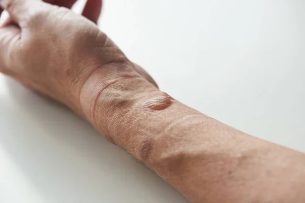 Second degree burn at left forearm and wrist — Stock Photo, Image