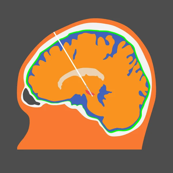 DBS at subthalamic nucleus for the treatment of parkinson's dise — 스톡 벡터