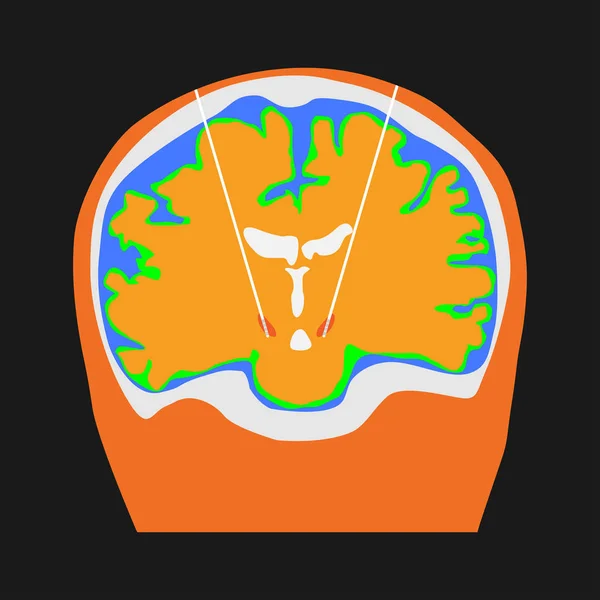 DBS al nucleo subtalamico per il trattamento del dise del parkinson — Vettoriale Stock