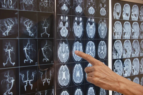 Рука, указывающая на МРТ мозга на световом ящике — стоковое фото