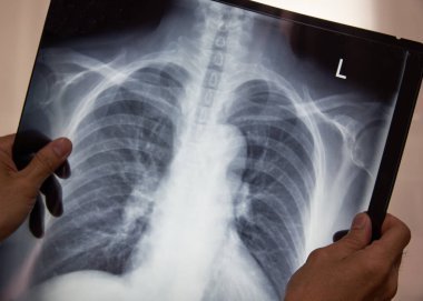 Doctor reading chest x-ray film 