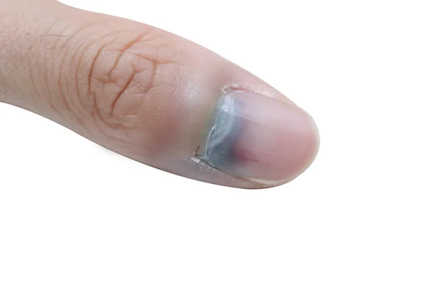 yaralı parmak ve çürük çivi