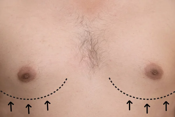 Нарисовать линию на груди мужчины для пластической хирургии сисек — стоковое фото