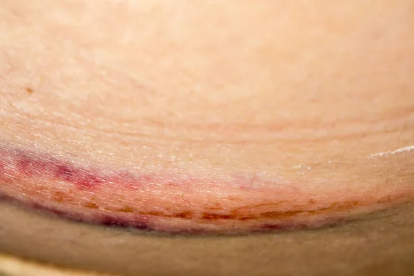 Hematomas na pele — Fotografia de Stock