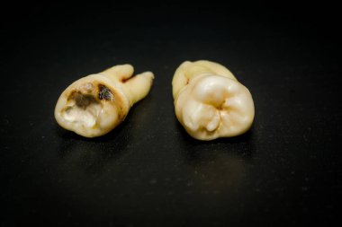 Diş çıkarma sonra