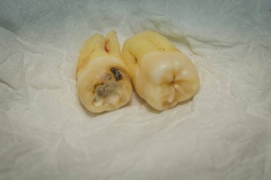 Diş çıkarma sonra