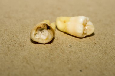 Diş çıkarma sonra