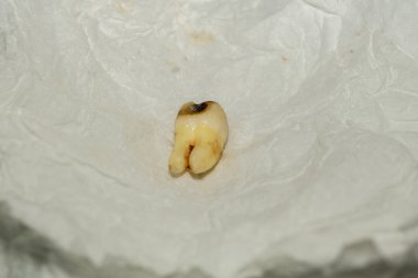 Diş çıkarma sonra