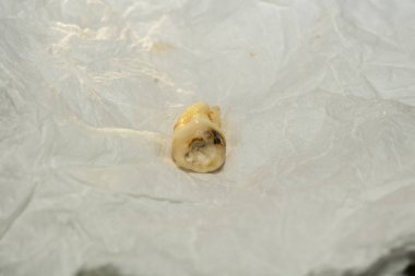 Diş çıkarma sonra