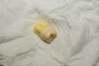 Diş çıkarma sonra