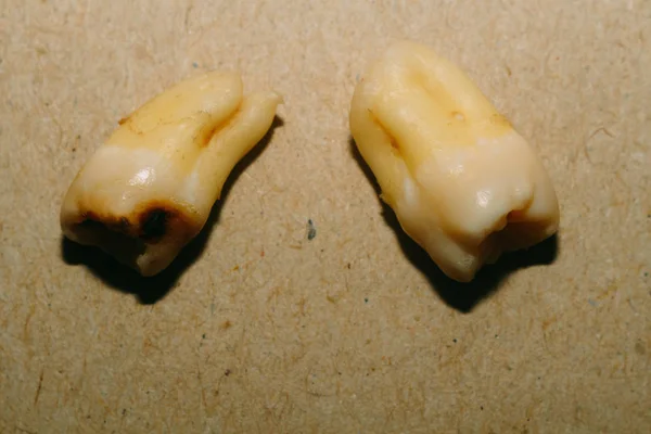 Ząb po ekstrakcji — Zdjęcie stockowe