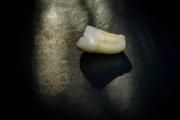 Ząb po ekstrakcji — Zdjęcie stockowe