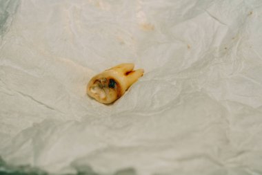 Diş çıkarma sonra