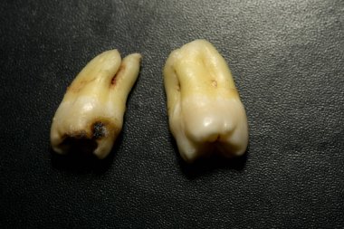 Diş çıkarma sonra