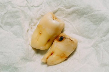 Diş çıkarma sonra