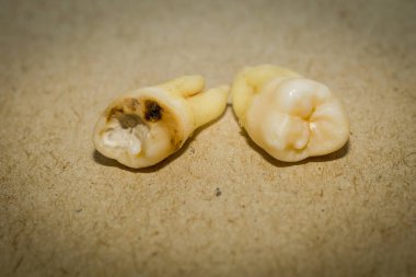 Diş çıkarma sonra