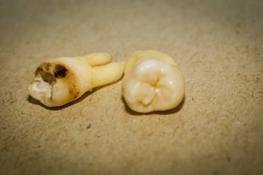 Diş çıkarma sonra