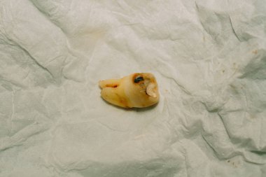 Diş çıkarma sonra