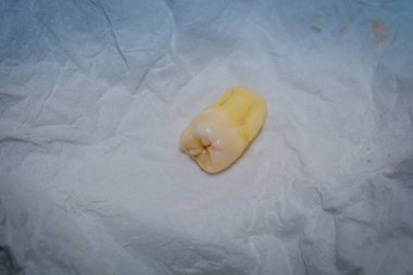 Diş çıkarma sonra